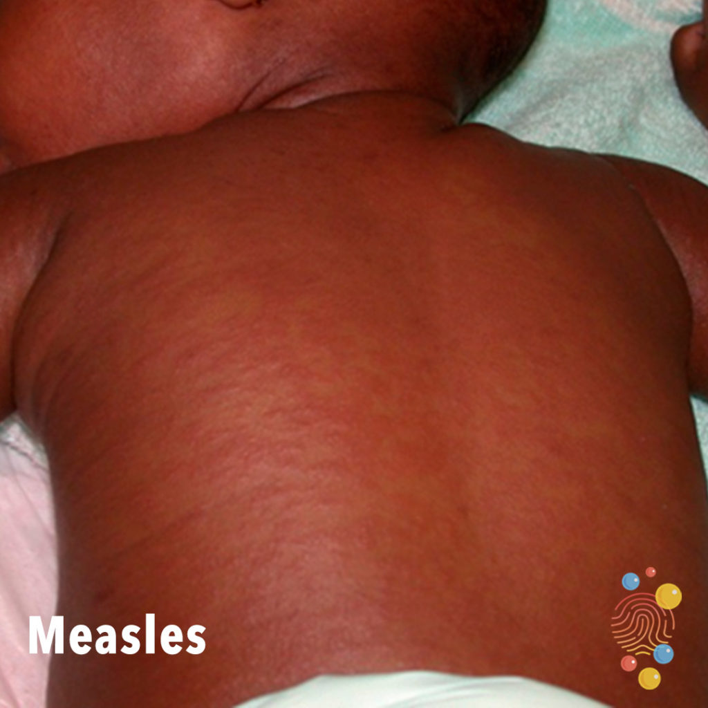 Measles rash shown on child's back