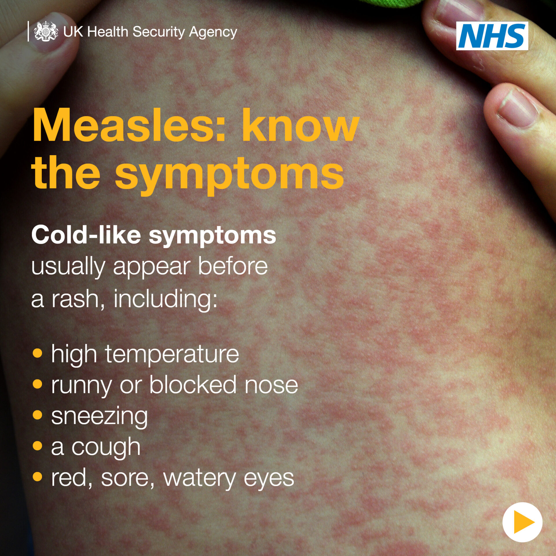 UKHSA measles 2